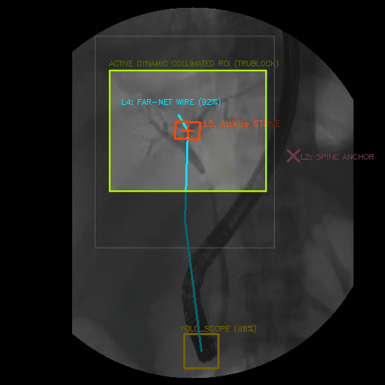 Clinical Clip 1 Lithotripsy Tracking